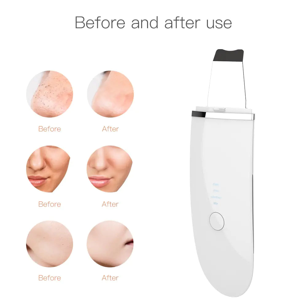 Ultrasonic Face Spatula Skin Scrubber – Wireless