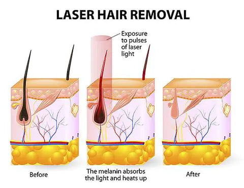 New Laser Hair Removal Device and Shaver